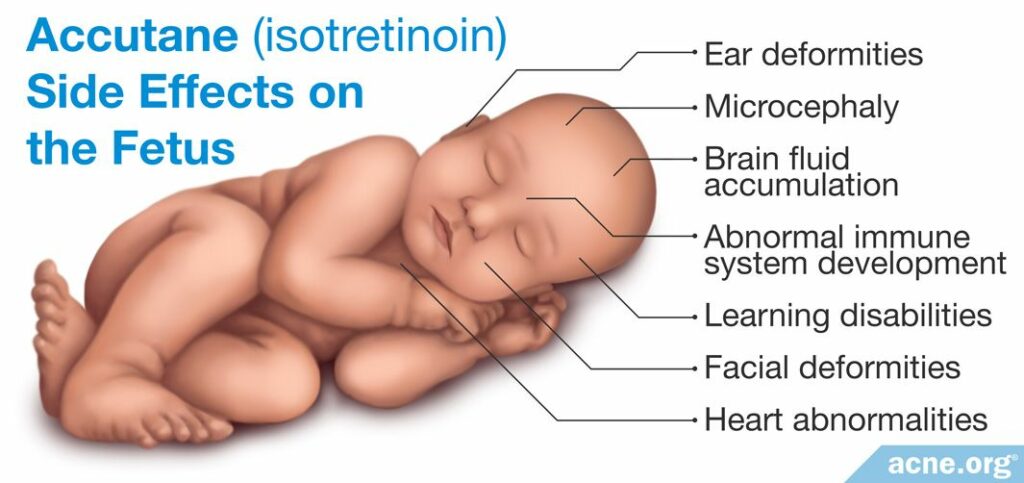 Accutane (Isotretinoin) Side Effects on the Fetus