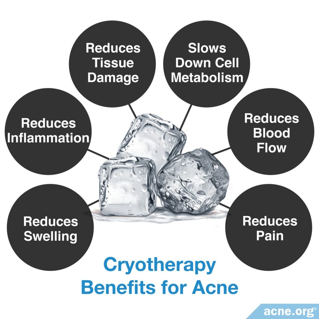 Cryotherapy Benefits for Acne