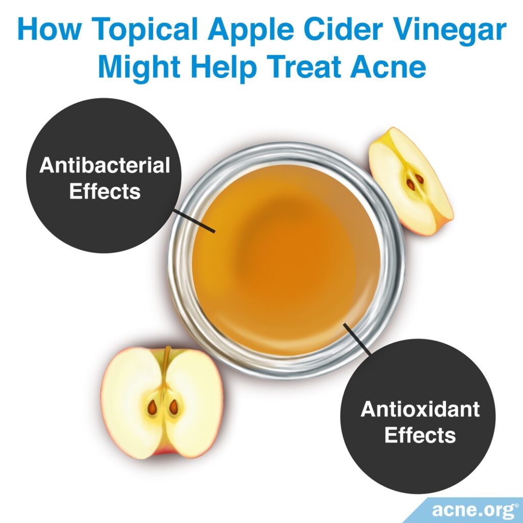 How Topical Apple Cider Vinegar Might Help Treat Acne