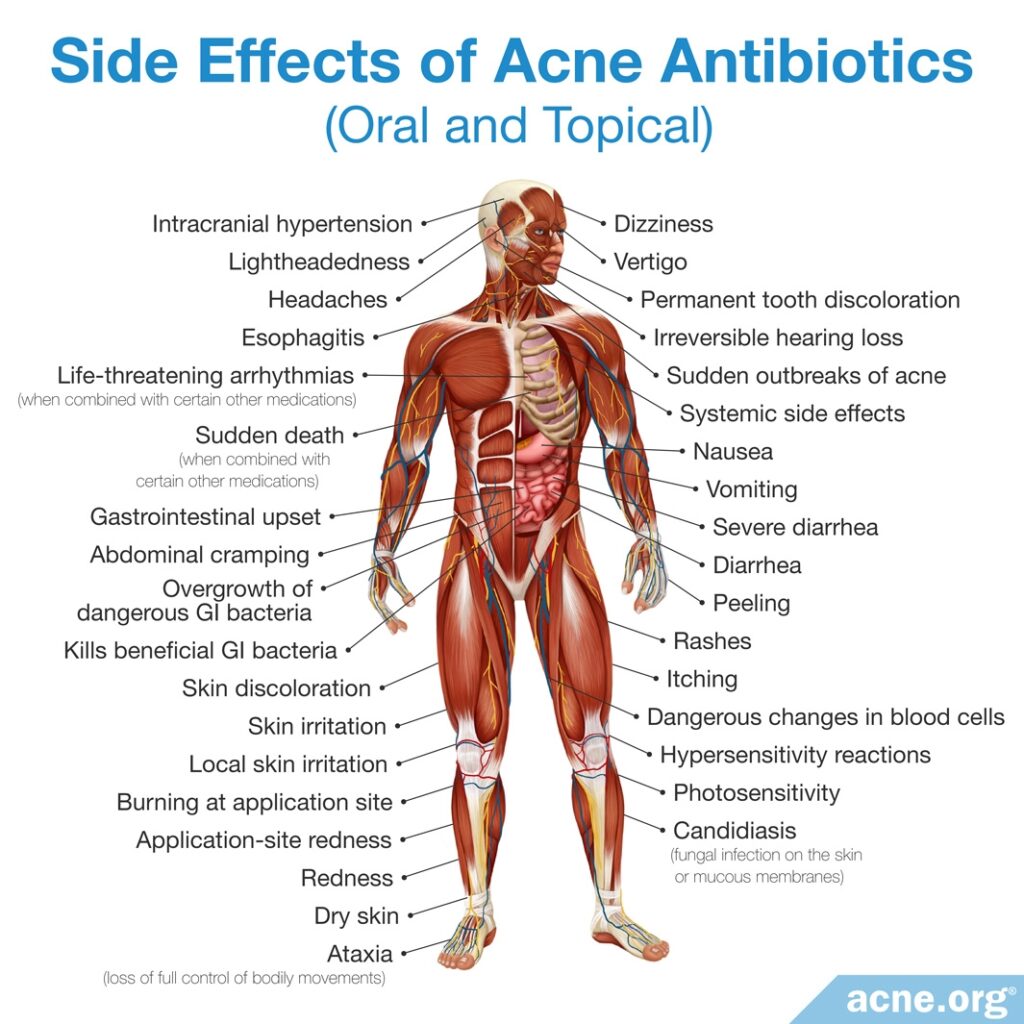 Side Effects of Oral and Topical Antibiotics for Acne