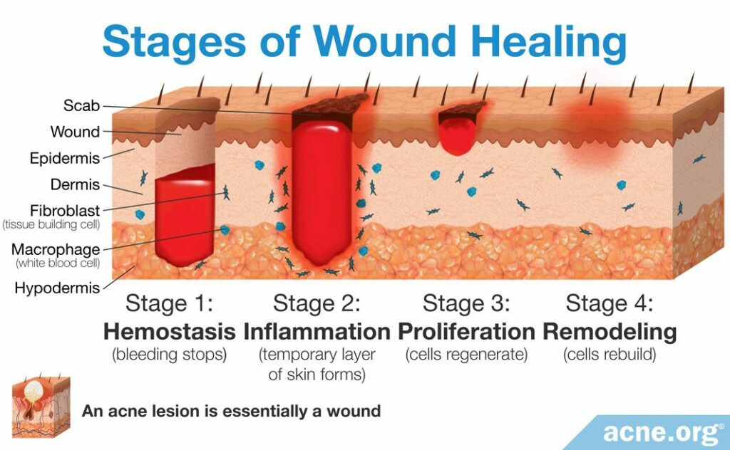 Stages of Wound Healing