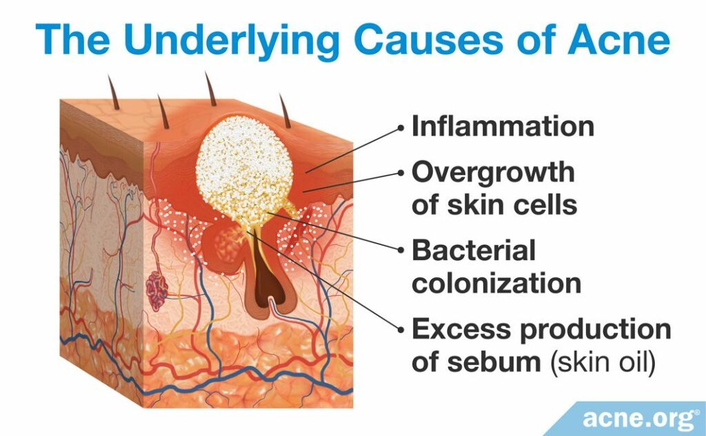 The Underlying Causes of Acne