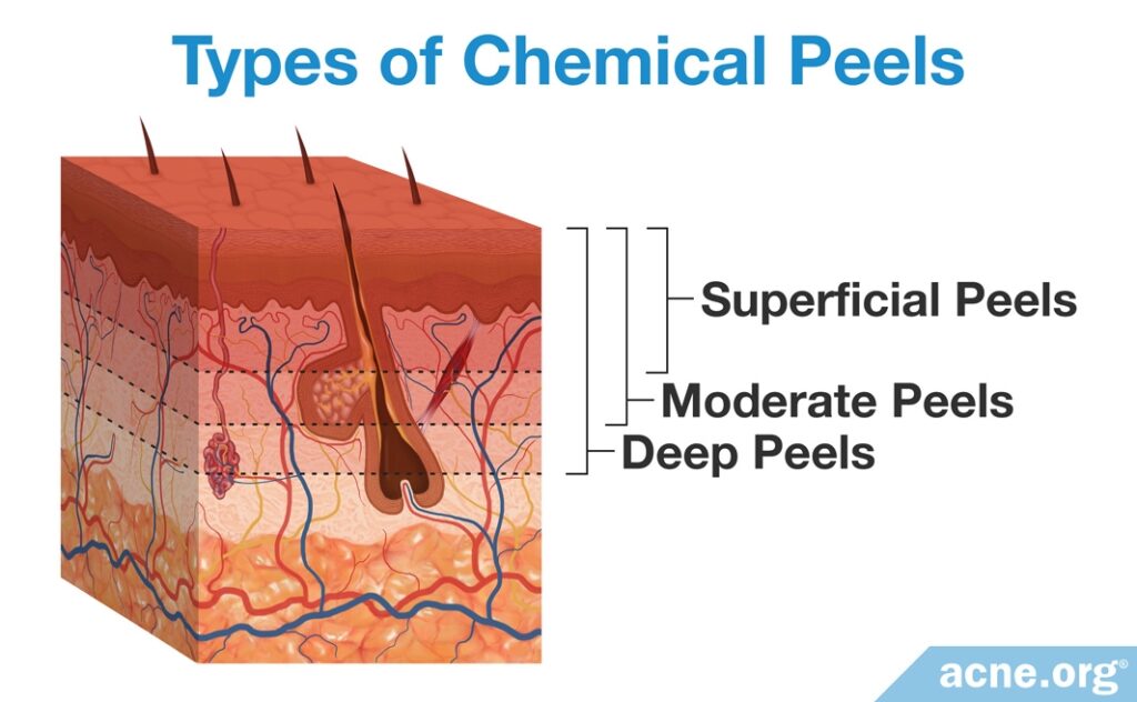 Types of Chemical Peels