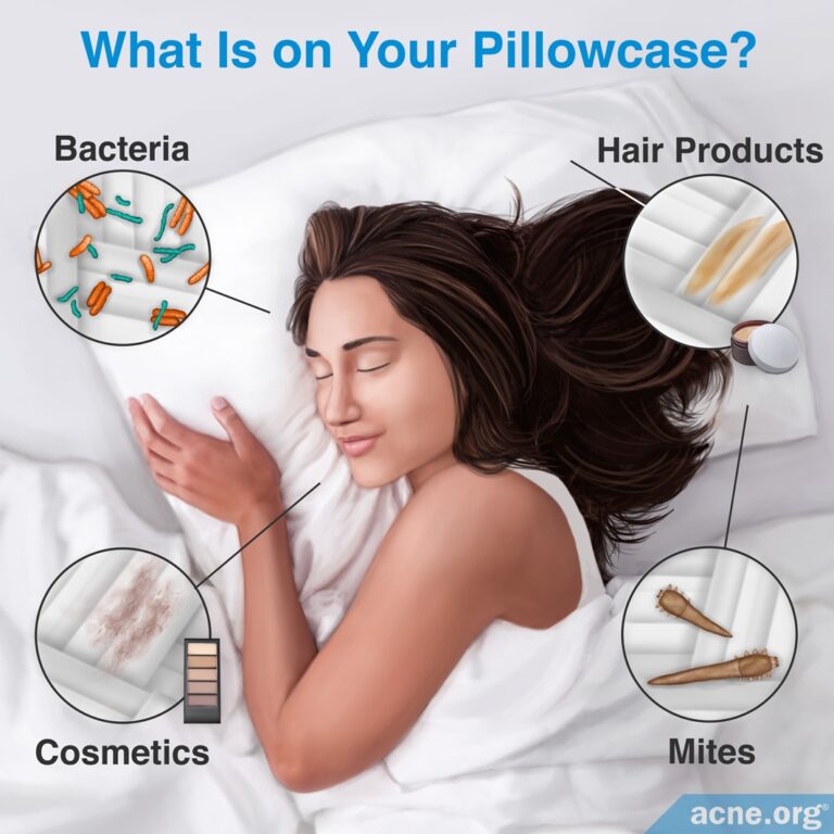 How Often Should an Acneprone Person Change His/Her Pillowcase?