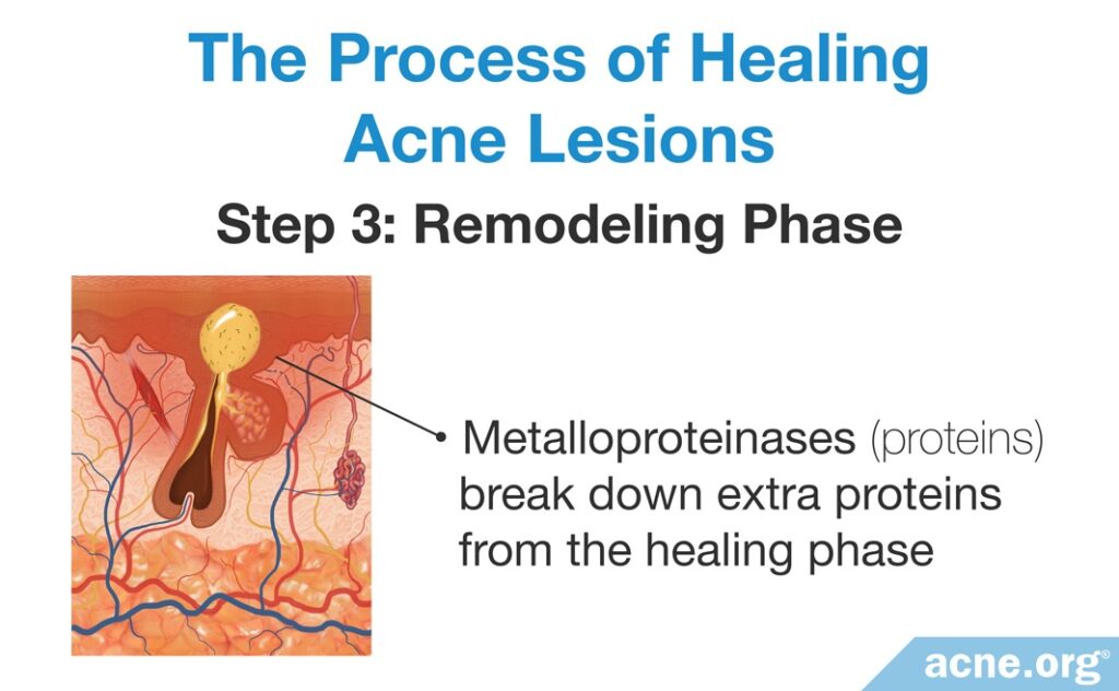 The Process of Healing Acne Lesions: Remodeling Phase