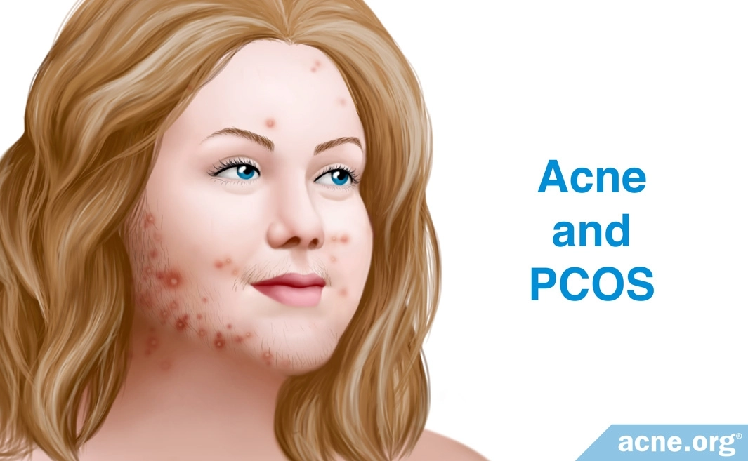 polycystic ovarian syndrome acne