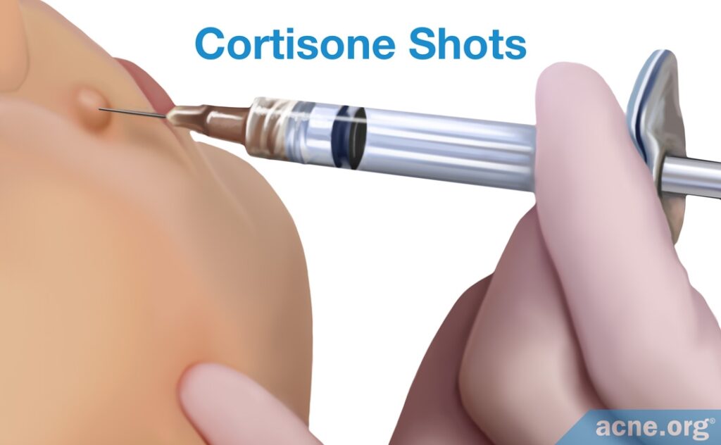 Cortisone Shots