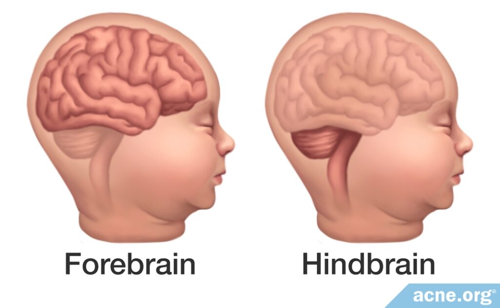 Forebrain - Hindbrain