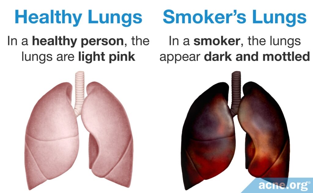 Healthy Lungs / Smoker's Lungs