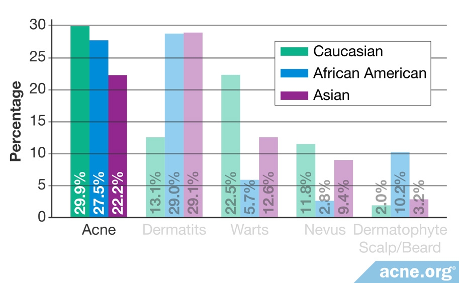 Percentage of Acne by Ethnicity