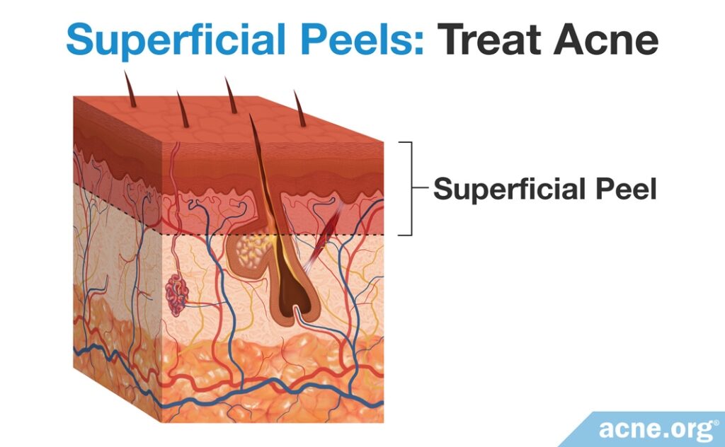 Superficial Chemical Peels - Treat Acne