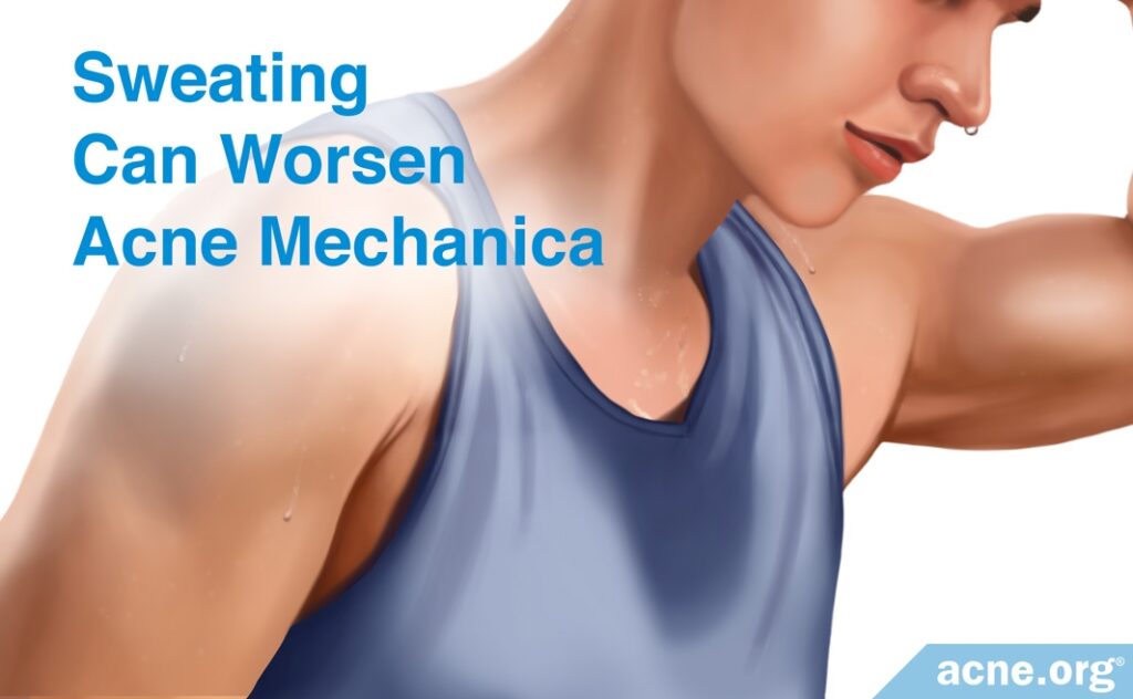 Sweating Can Make Acne Mechanica Worse