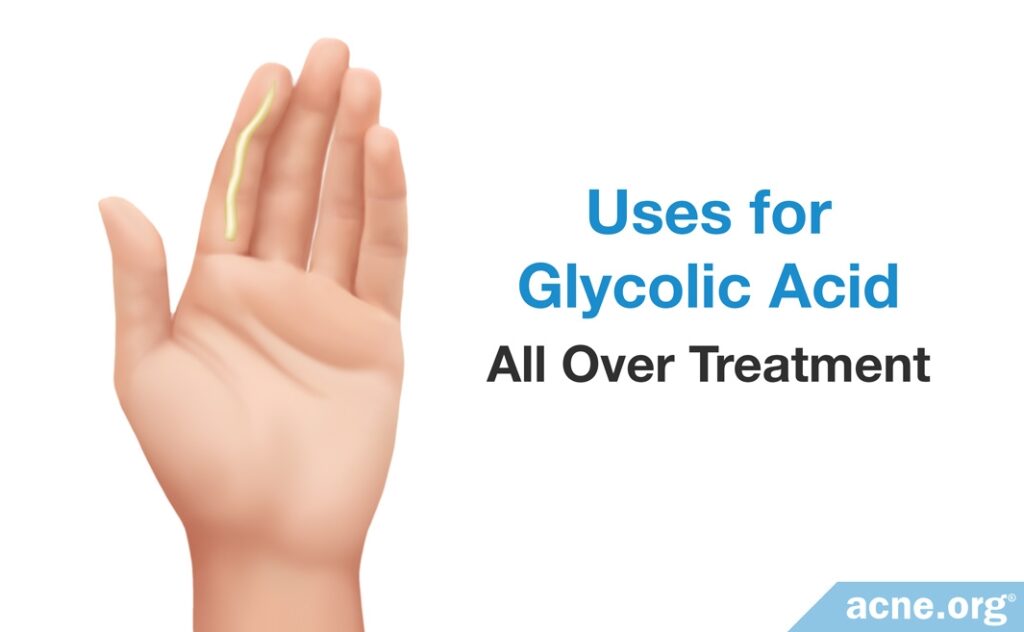 Uses for Glycolic Acid: All Over Treatment