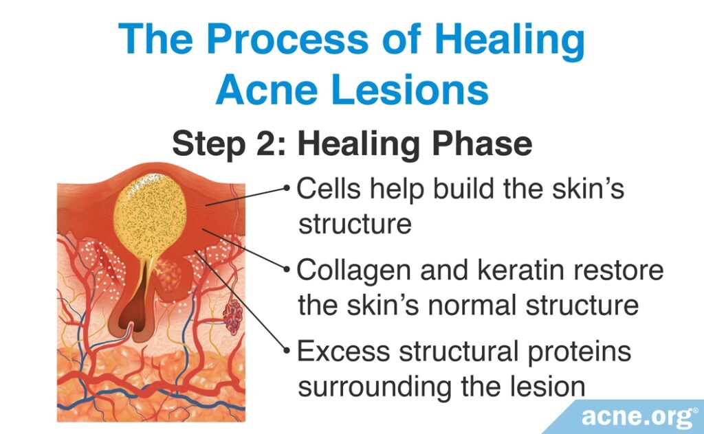 The Process of Healing Acne Lesions: Healing Phase