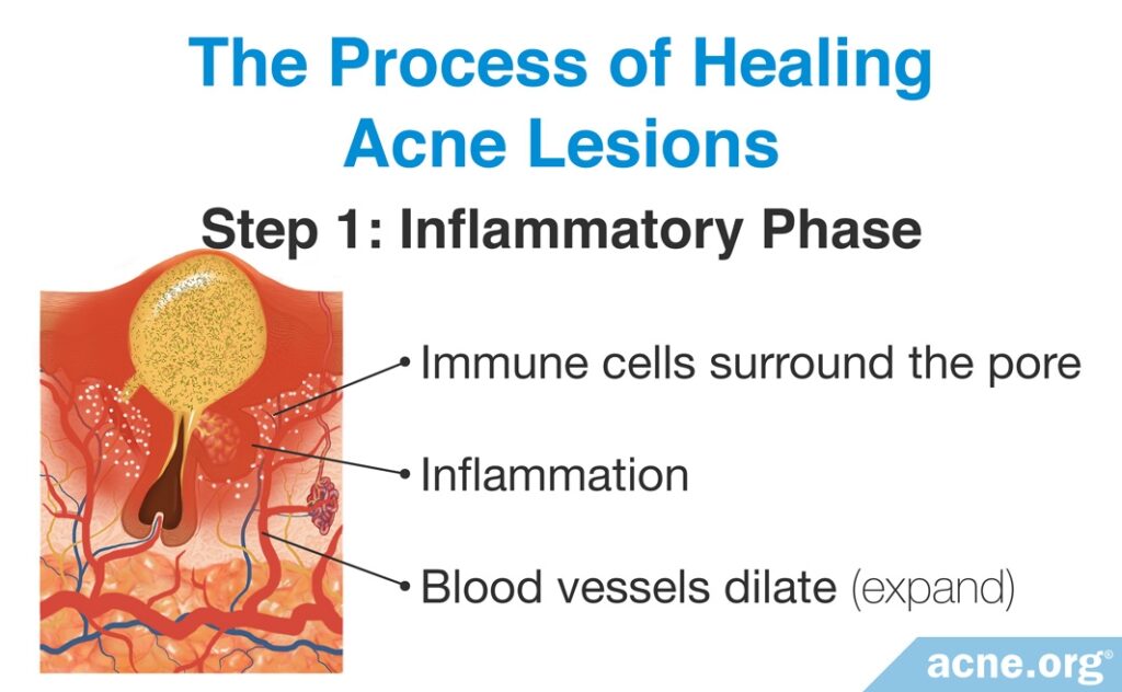 The Process of Healing Acne Lesions: The Inflammatory Phase