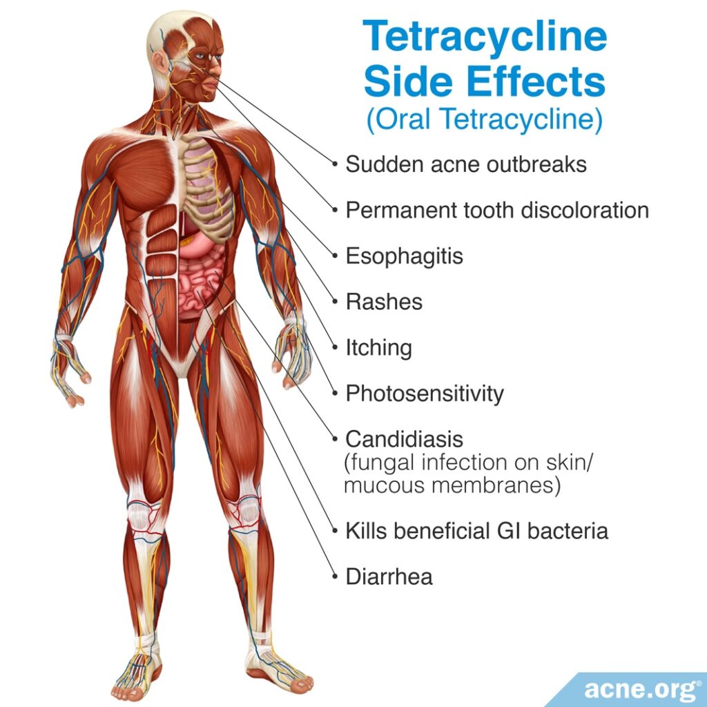 Tetracycline Side Effects