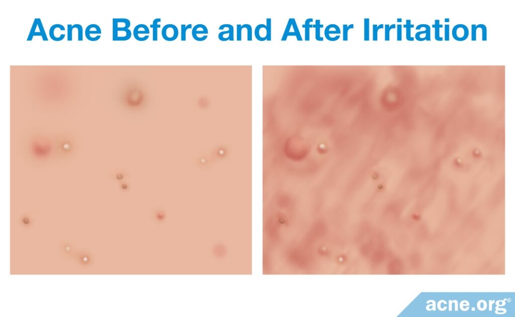 Acne Before and After Irritation