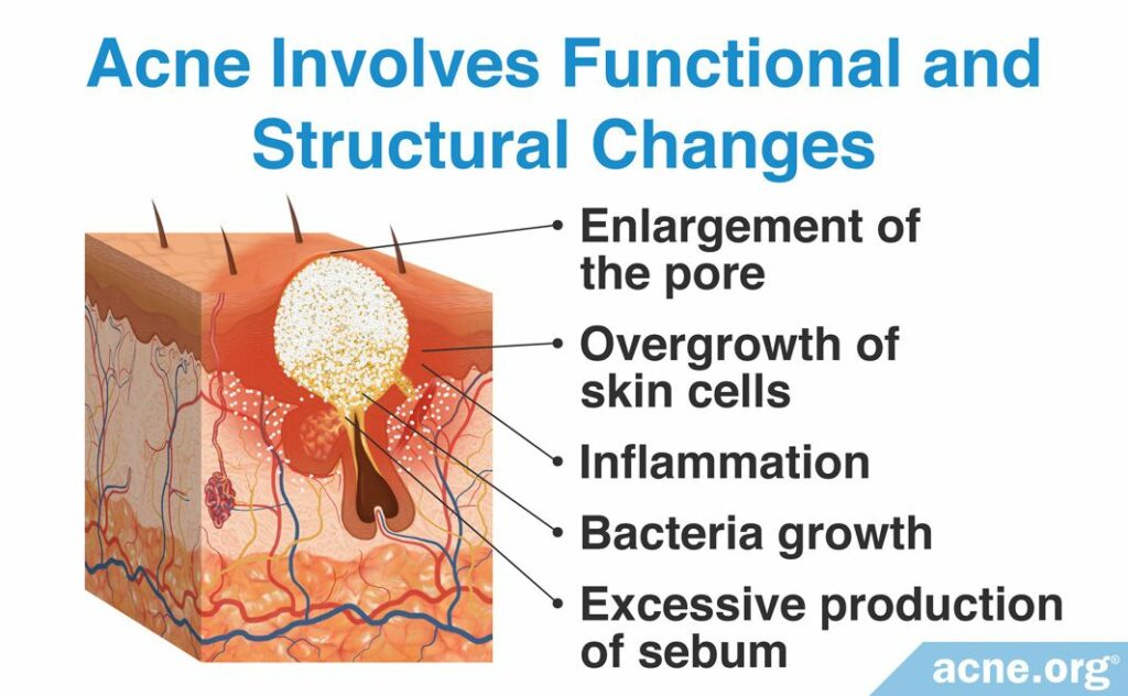 Acne Involves Functional and Structural Changes