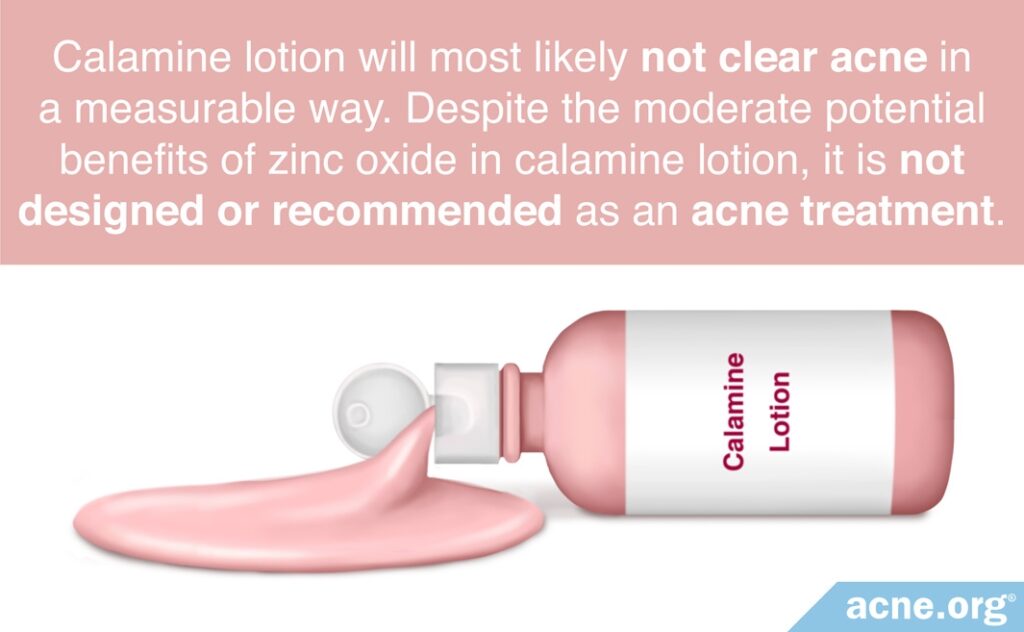 Calamine Lotion Will Most Likely Not Clear Acne in a Measurable Way
