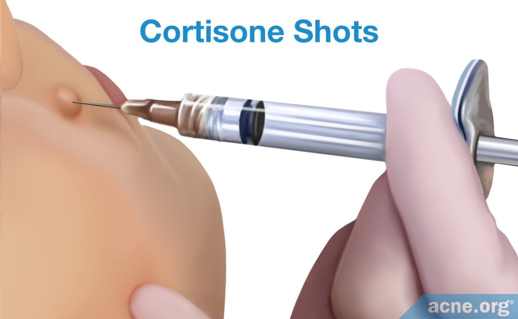 Cortisone Shots