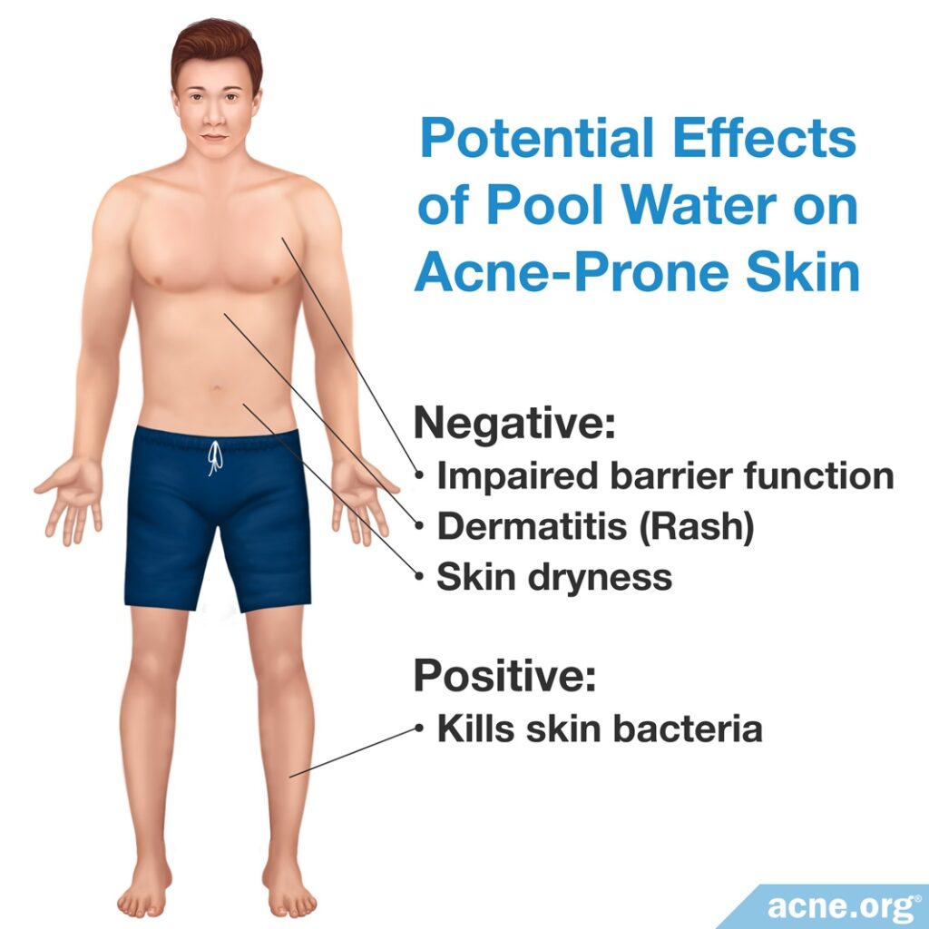 Potential Effects of Pool Water on Acne-Prone Skin