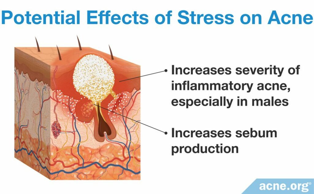 Potential Effects of Stress on Acne