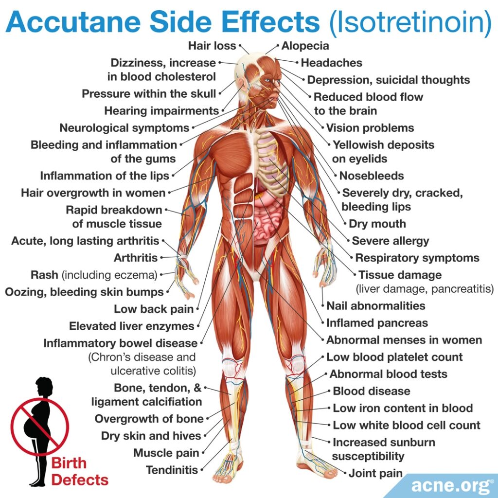 Side Effects of Isotretinoin (Accutane)