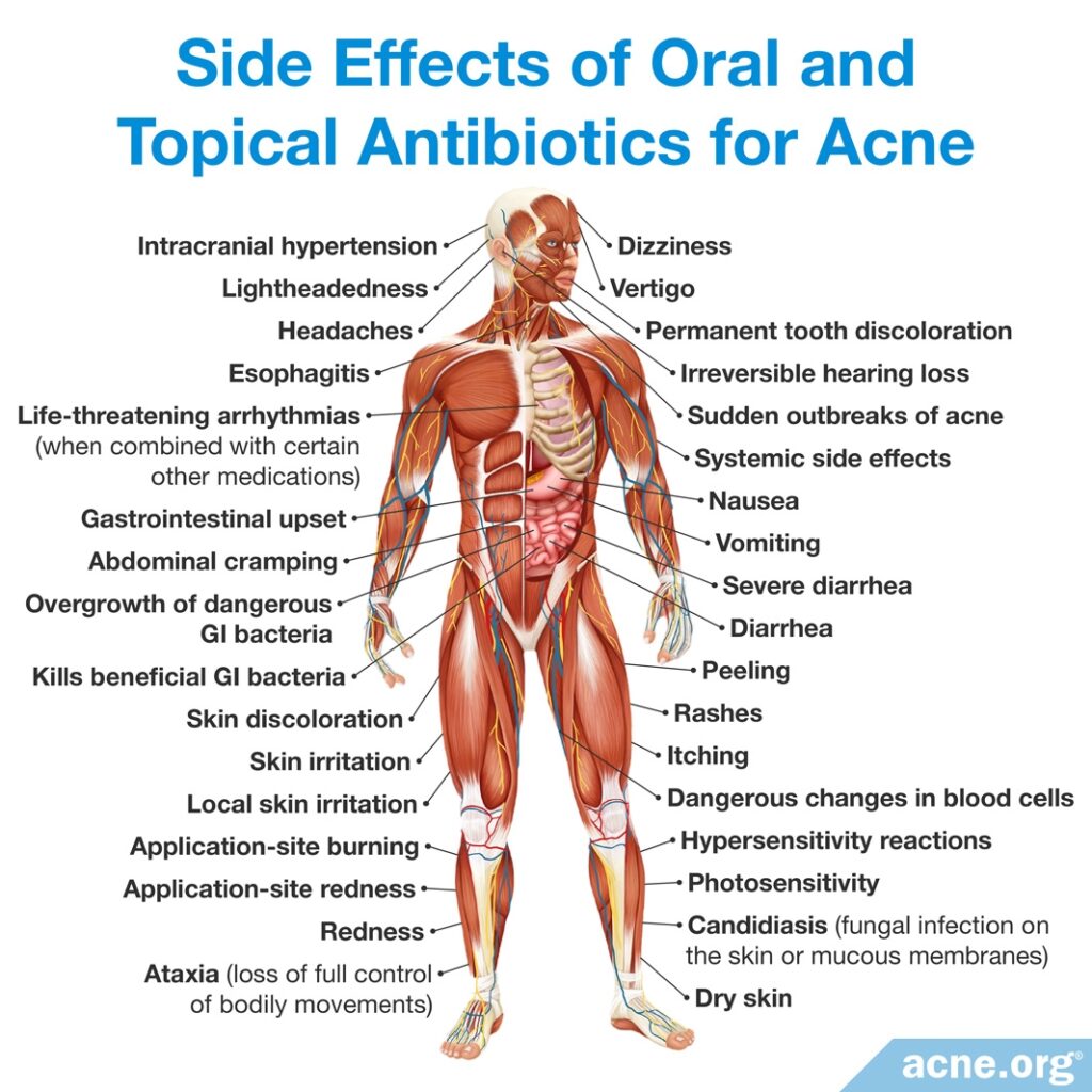 Side Effects of Oral and Topical Antibiotics for Acne