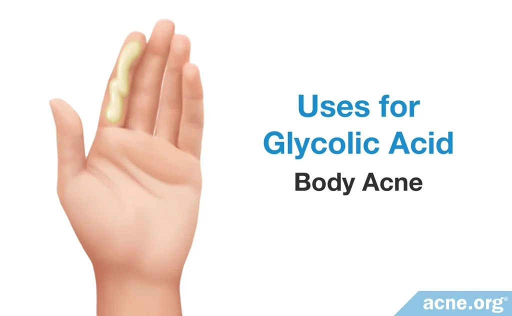 Uses for Glycolic Acid: Body Acne