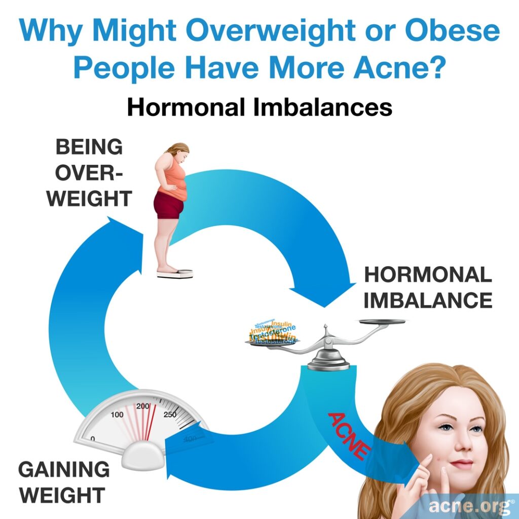 Why Overweight or Obese People Might Have More Acne: Hormonal Imbalances