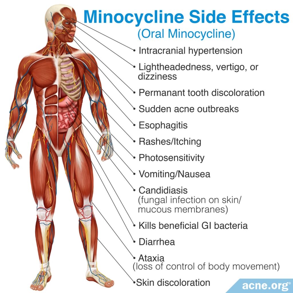 Minocycline Side Effects