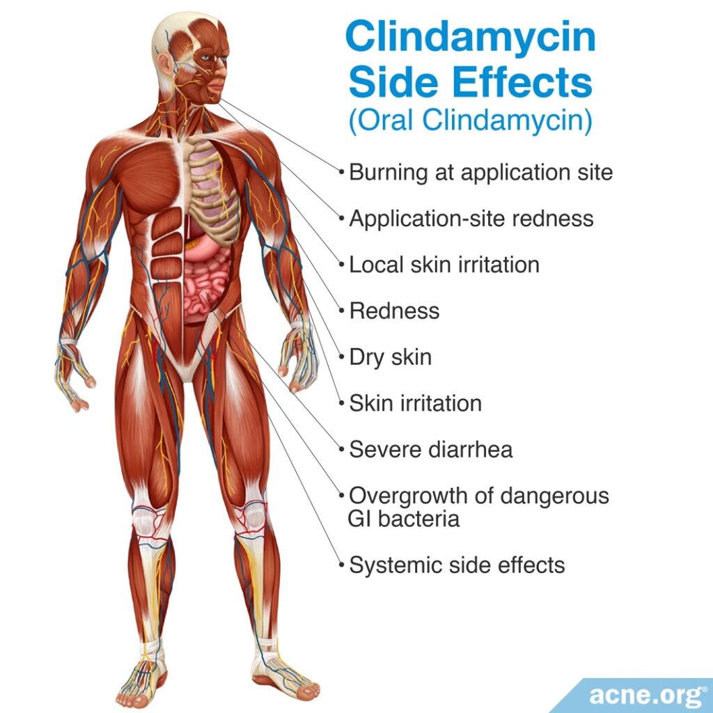 Clindamycin Side Effects