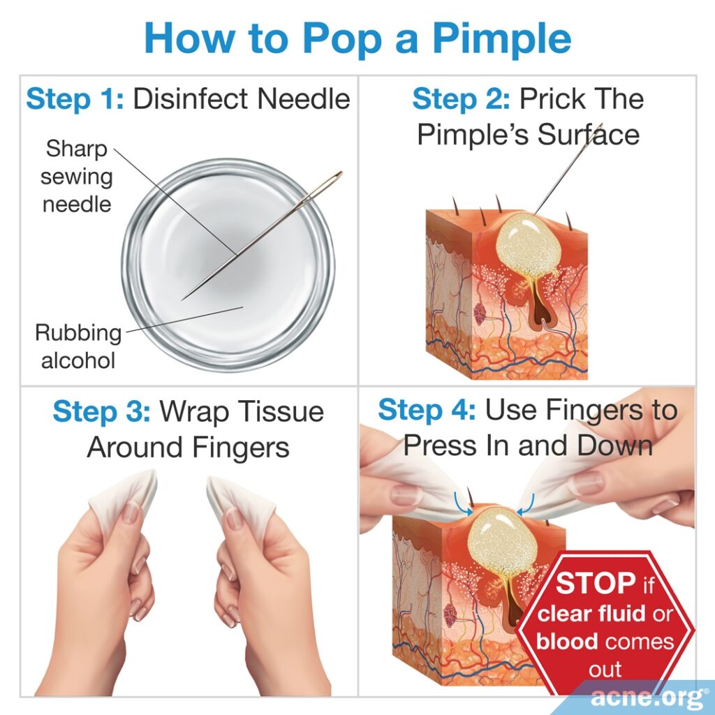 How to Pop a Pimple