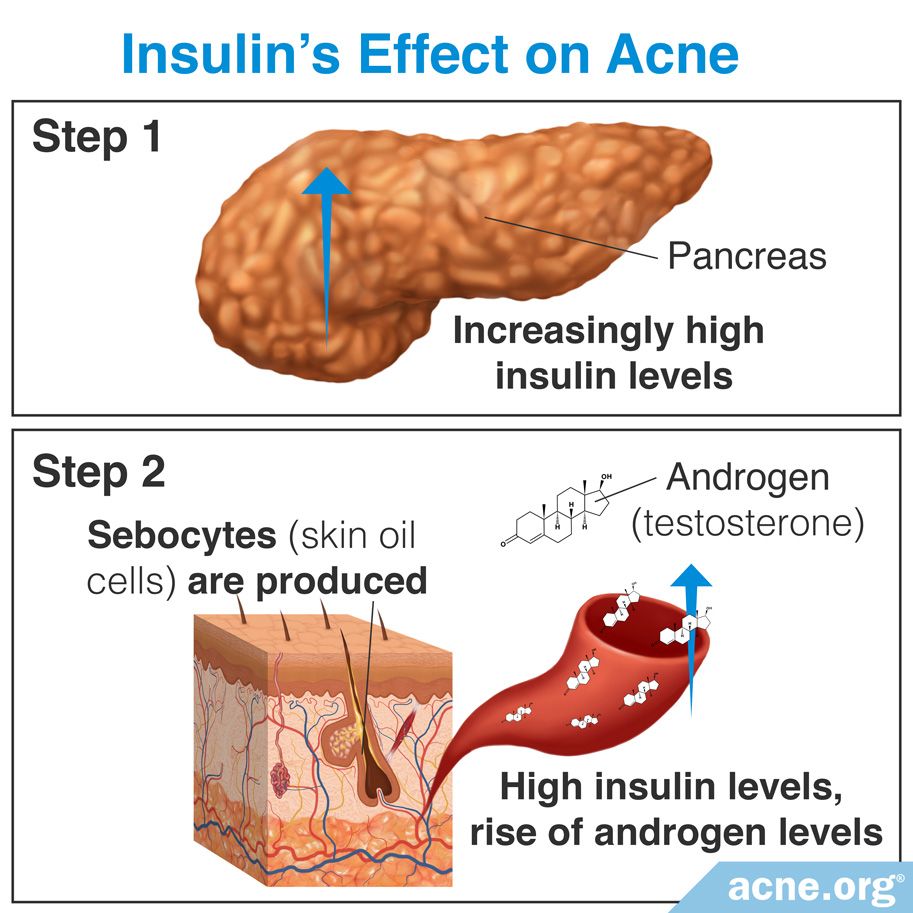 Insulin's Effect on Acne