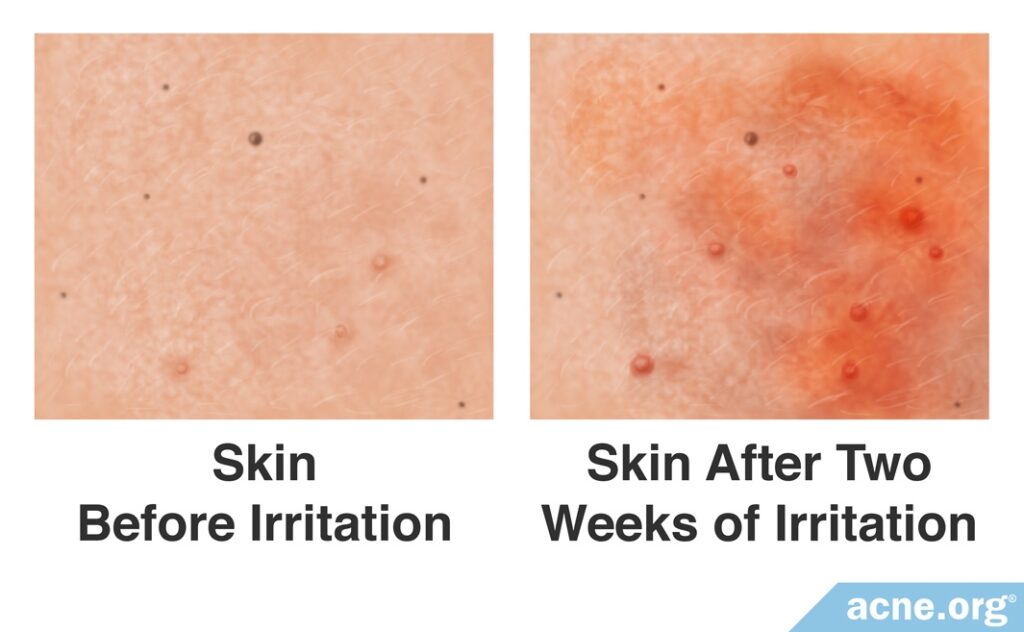 Skin Before and After Irritation