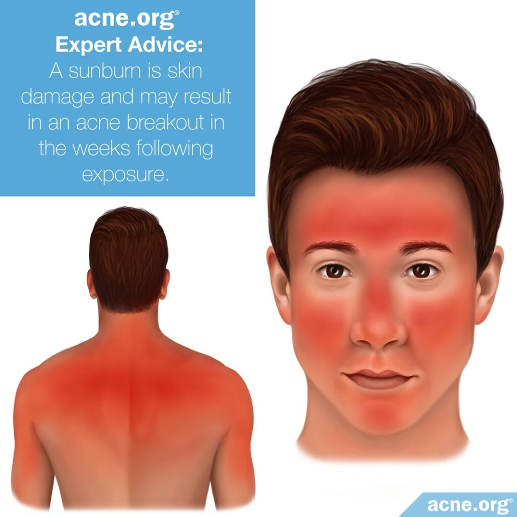 Acne.org Expert Advice: Sunburn