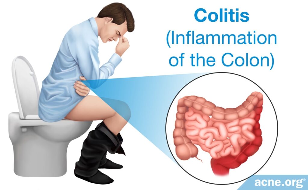 Colitis (Inflammation of the Colon)