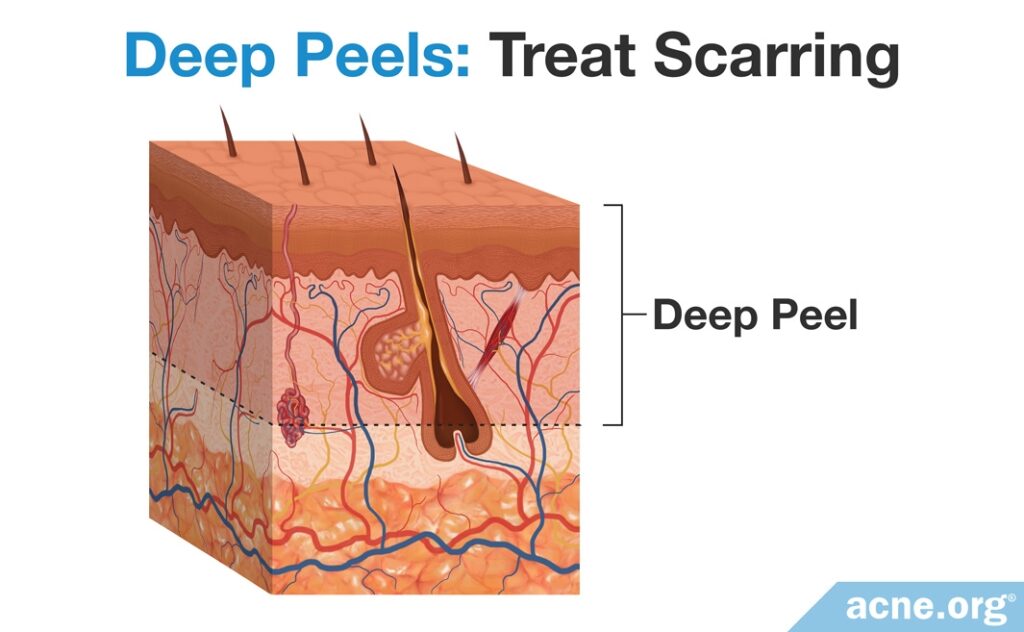 Deep Chemical Peels - Treat Scarring