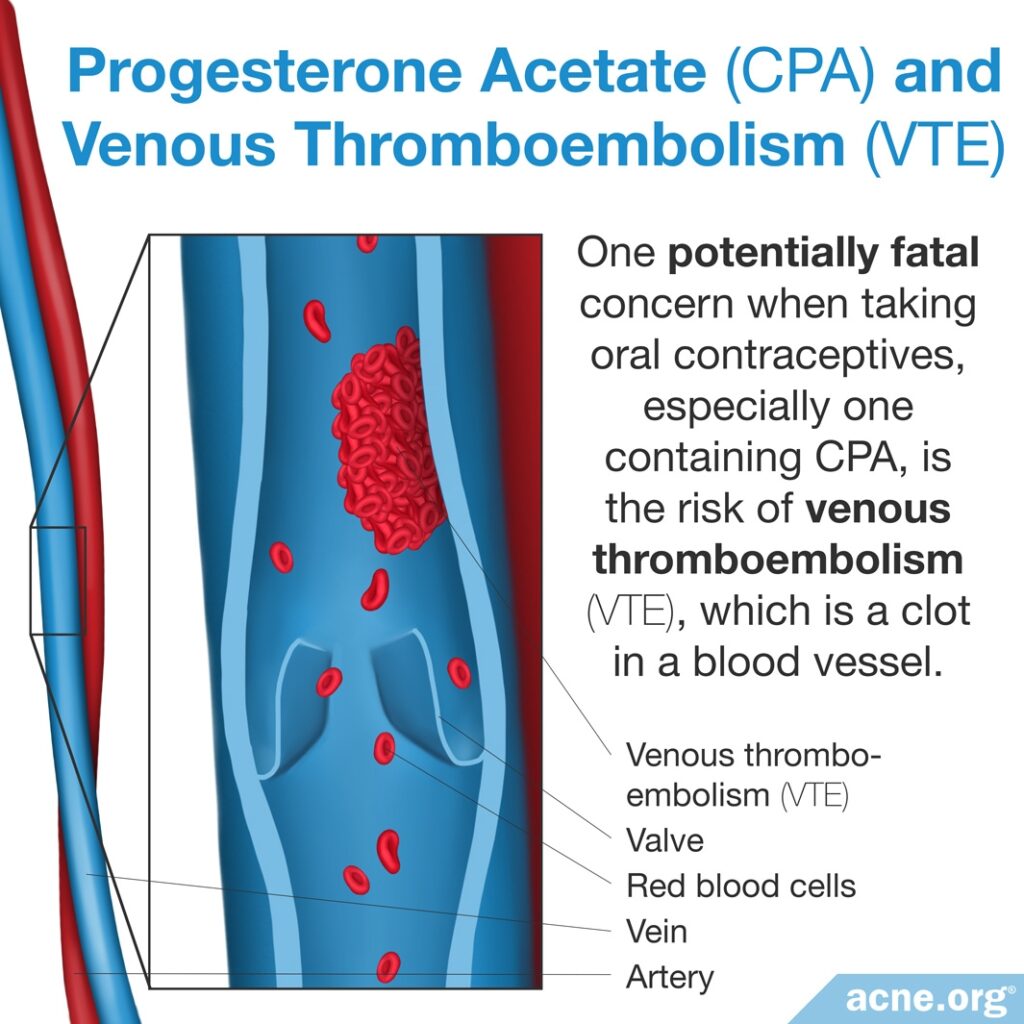 Progesterone Acetate and Venous Thromboembolism