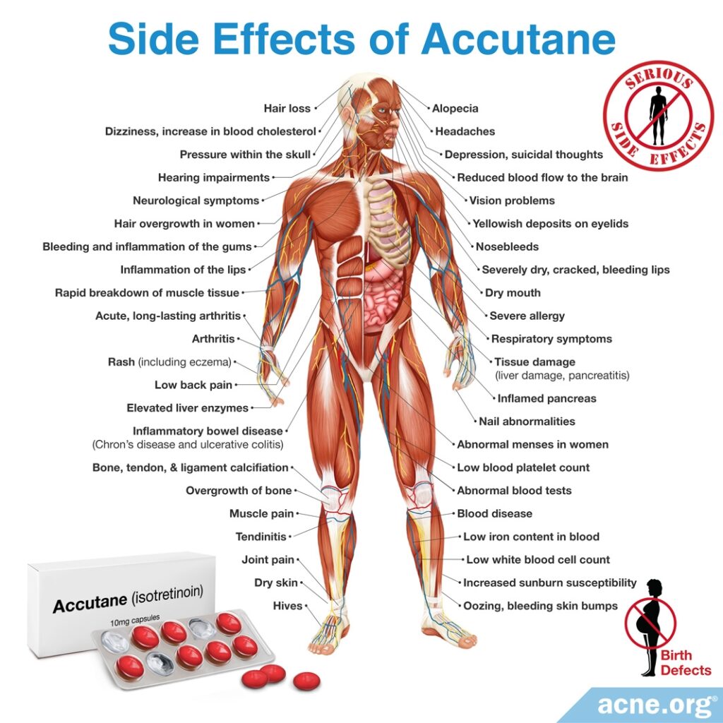 Side Effects of Accutane (isotretinoin)