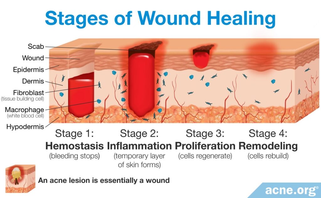 Stages of Wound Healing