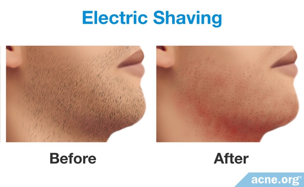 Before and After Electric Shaving