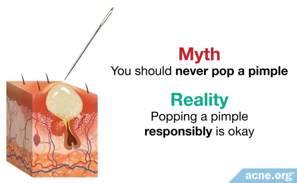 Myth: you should never pop a pimple