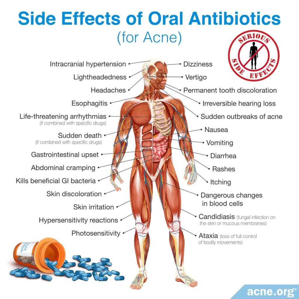 Side Effects of Oral Antibiotics for Acne