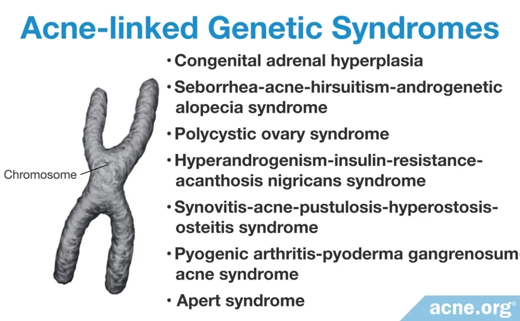 Genetic Syndromes Associated with Acne