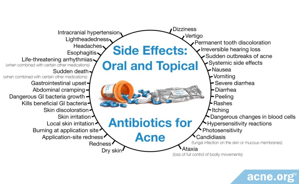 Side Effects of Oral and Topical Antibiotics for Acne