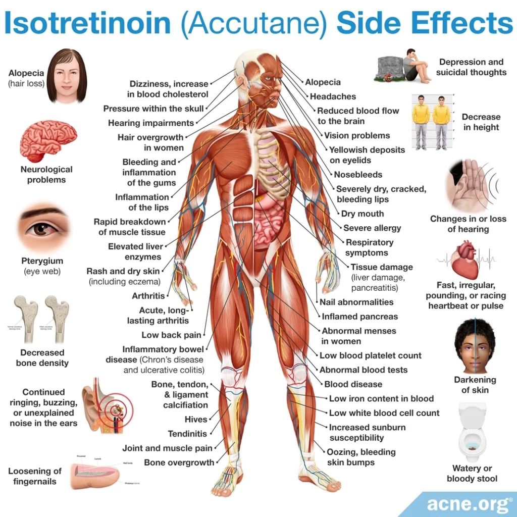 Side Effects of Accutane (Isotretinoin) for Acne