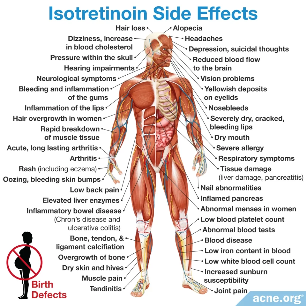 Isotretinoin Side Effects