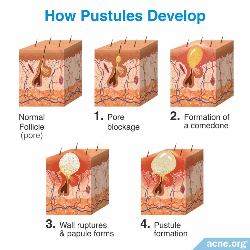 How Pustules Develop