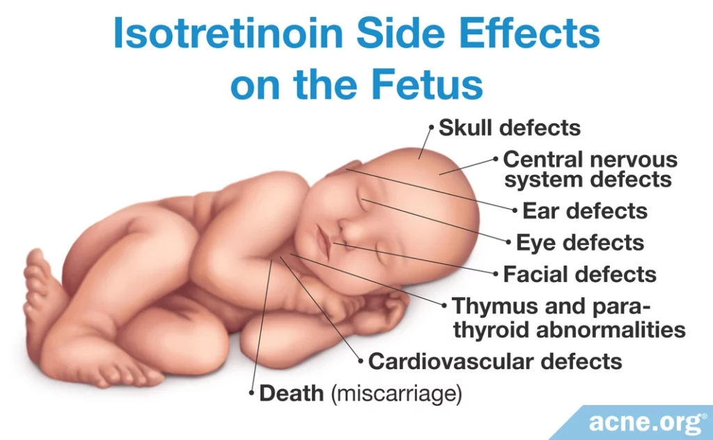 Isotretinoin Side Effects on the Fetus